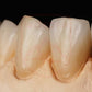 ST-C Pre-shaded zirconia 71mm system